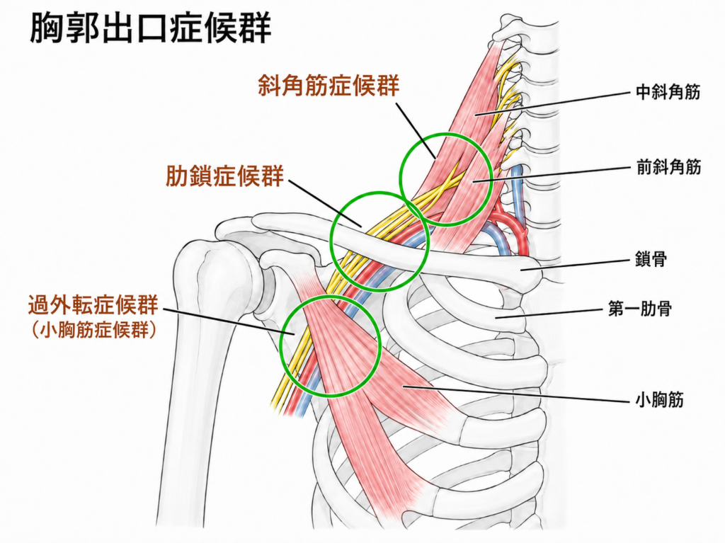 「胸郭出口症候群の圧迫部位イメージ図」